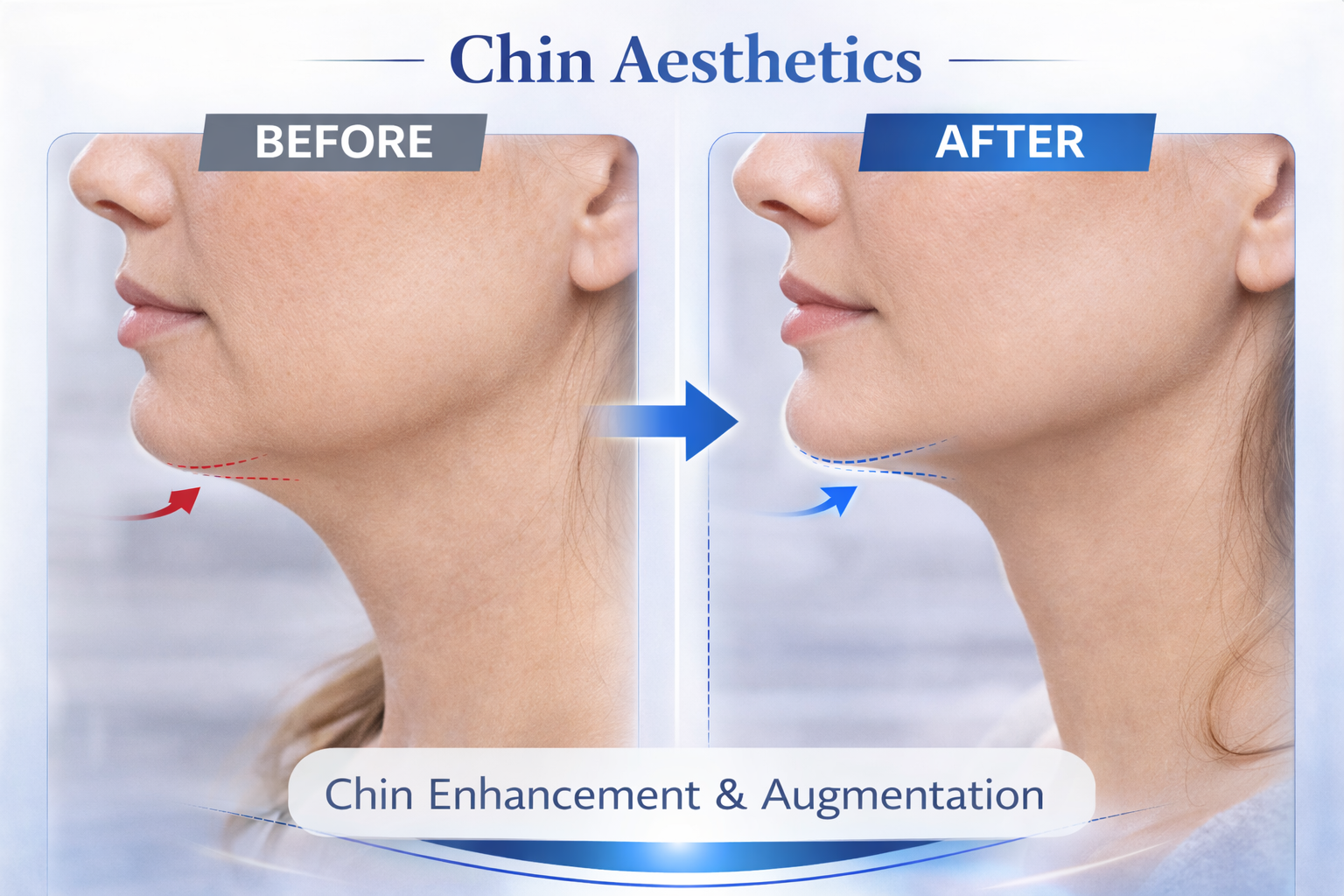 Chin Result